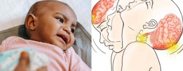 Le syndrome du bébé secoué